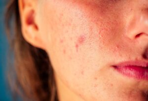 4 Guaranteed Ways To Get Rid Of That Nasty Summer Acne